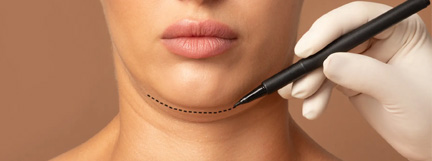 Non-Surgical Double Chin Reduction